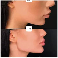 آموزش فیلر،بوتاکس،مزو،مزو ژل با مدرک|خدمات آموزشی|آبادان, |دیوار