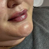فیلر ژل بوتاکس اف تا اخر هفته اف ویژه