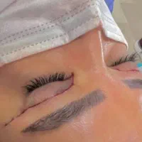 آف ویژه بلفاروپلاستی (عمل پلک بالا )۱۲ تومان