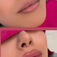 مدل برای تزریق ژل و بوتاکس