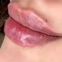 تخفیف اموزش فیلر و بوتاکس