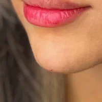 فیلر،بوتاکس،مزو،مزوژل،آنزیم