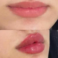 به چند نفر مدل تزریق ژل و بوتاکس نیازمندیم|خدمات آرایشگری و زیبایی|ارومیه, |دیوار