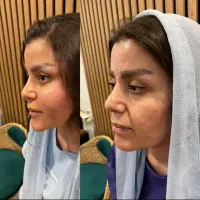 پکیج اقتصادی جوانسازی و لیفت اندوهایفو دکتر داریوش|خدمات آرایشگری و زیبایی|مشهد, راهنمایی|دیوار