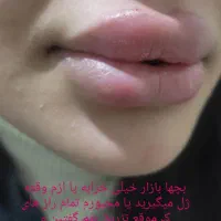تزریق ژل و بوتاکس