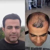 کاشت مو تنها با ۱۵ میلیون تومان