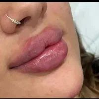 اف ویژه ژل بوتاکس پرسینگ|خدمات آرایشگری و زیبایی|شیراز, شهرک مطهری|دیوار