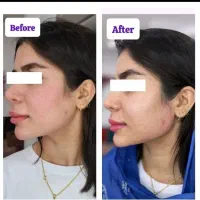 جشنواره تخفیفات یک روزه انجام فیلرزاویه فک وگونه|خدمات آرایشگری و زیبایی|تبریز, |دیوار