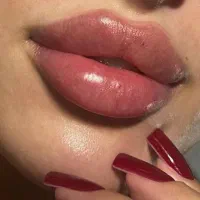 ژل بوتاکس فیلر زاویه ژل لب مطب پزشک