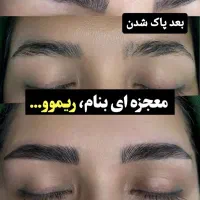 ریموو تک جلسه با تخفیف ویژه