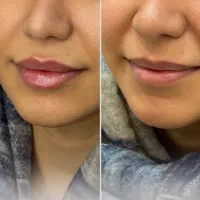 تزریق ژل و بوتاکس