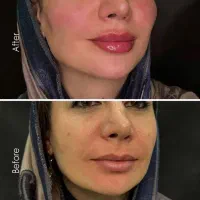 جشنوارتخفیفات ژل و بوتاکس توسط شخص پزشک|خدمات آرایشگری و زیبایی|قم, زنبیل آباد|دیوار