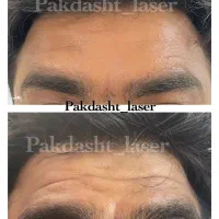 تزریق بوتاکس مصپورت ، کامل صورت توسط پزشک|خدمات آرایشگری و زیبایی|پاکدشت, پاکدشت (مامازند)|دیوار