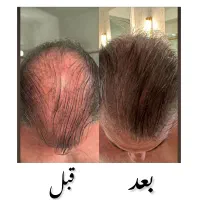 رویش تضمینی مو