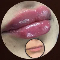 فیلر ، بوتاکس ،پیرسینگ