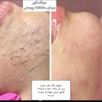 پاکسازی،فیشیال تخصصی،درمان مشکلات پوستی(تخفیف)|خدمات آرایشگری و زیبایی|گرگان, |دیوار