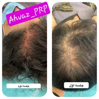 درمان قطعی ریزش مو با PRP