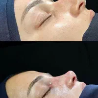 جراحی زیبایی بینی( رینوپلاستی) توسط متخصص ent