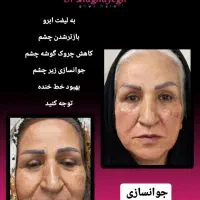 لیزر تزریق بوتاکس ژل فیلر مزوتراپی هایفو توسط پزشک|خدمات آرایشگری و زیبایی|پرند, فاز ۲|دیوار