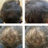 دیگه نگران کم پشتی موهات نباش