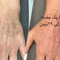 لیزر انواع خال مادرزادی کک مک پلاسما صورت