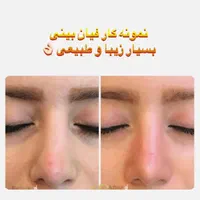 جوانسازی صورت بدون جراحی با تخفیف ویژه|خدمات آرایشگری و زیبایی|تهران, اقدسیه|دیوار