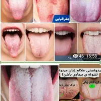 تشخیص عارضه ها از روی زبان