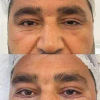 بلفا رو،بلفاروپلاستی،لیفت شقیقه،اتوپلاستی،ساکشن غب|خدمات آرایشگری و زیبایی|اهواز, نادری|دیوار