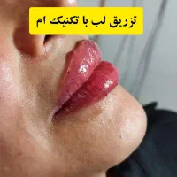 تزریق ژل لب،تزریق ژل گونه ،تزریق ژل چانه، بوتاکس|خدمات آرایشگری و زیبایی|ساری, |دیوار