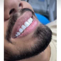 خدمات لمینیت و کامپوزیت دندان و پروتزهای دندانی|خدمات آرایشگری و زیبایی|کرج, گلشهر|دیوار