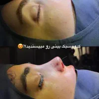 فرصت استثنایی وباورنکردنی عمل بینی بصورت اقساط|خدمات آرایشگری و زیبایی|ایذه, |دیوار