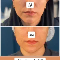 هایفوتراپی14بعدی برای نخستین بار در غرب کشور|خدمات آرایشگری و زیبایی|خرم‌آباد, |دیوار