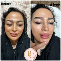 تزریق فیلر لب بادی بوتاکس فول فیس بلفارو غبغب|خدمات آرایشگری و زیبایی|تهران, نیاوران|دیوار