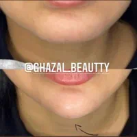 تزریق ژل بوتاکس چربیسوزی آنزیم جوانسازی|خدمات آرایشگری و زیبایی|اهواز, کیانپارس |دیوار