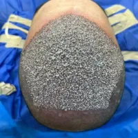کاشت مو و ابرو ریمو تتو با دستگاه پیشرفته اهواز|خدمات آرایشگری و زیبایی|خرمشهر, |دیوار