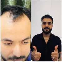 کاشت مو روش سوپر FUE پلاس(روش شیرازی)فقط ۱۵ میلیون|خدمات آرایشگری و زیبایی|یزد, |دیوار