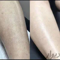 جشنواره لیزر موهای زائد با تیتانیوم پلاس 2025|خدمات آرایشگری و زیبایی|بوشهر, |دیوار