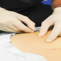 لاغری با امبدینگ (نخ لاغری و لیفت)