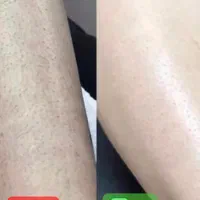 لیزر موهای زائد بانوان فول بادی  فقط ۲۹۹ مدت محدود|خدمات آرایشگری و زیبایی|تبریز, |دیوار
