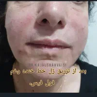 مطب زیبایی دکتر کژال شاه ویسی تزریق ژل بوتاکس..|خدمات آرایشگری و زیبایی|سنندج, |دیوار