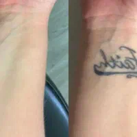 حذف تتو و خدمات پیلینگ