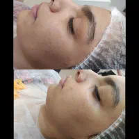 پاکسازی پوست با بهترین متریال|خدمات آرایشگری و زیبایی|مشهد, کوی المهدی|دیوار