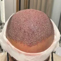 کاشت مو پرتراکم تضمینی