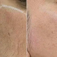 لیزر موهای زائد بانوان فول بادی  فقط ۲۹۹ مدت محدود|خدمات آرایشگری و زیبایی|تبریز, |دیوار