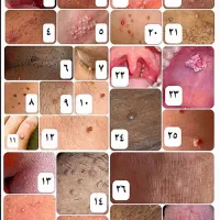 ازبین برندن زگیل تناسلی درکمتراز۱۵روزوبهبودی کامل|خدمات آرایشگری و زیبایی|گرگان, |دیوار