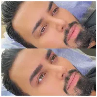 میکروبلیدینگ ، شیدینگ لب اقایان