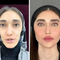 تزریق ژل 600بوتاکس زاویه فک از600لب جوانساز لیزر