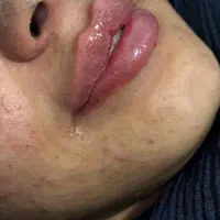 فیلر ،بوتاکس، آنزیم، مزوژل، پی ار پی