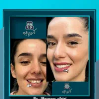 عصب کشی دندان باقیمت منصفانه ، جشنواره دندانپزشکی