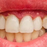 کامپوزیت لبه شیشه ای واحدی ۱ میلیون